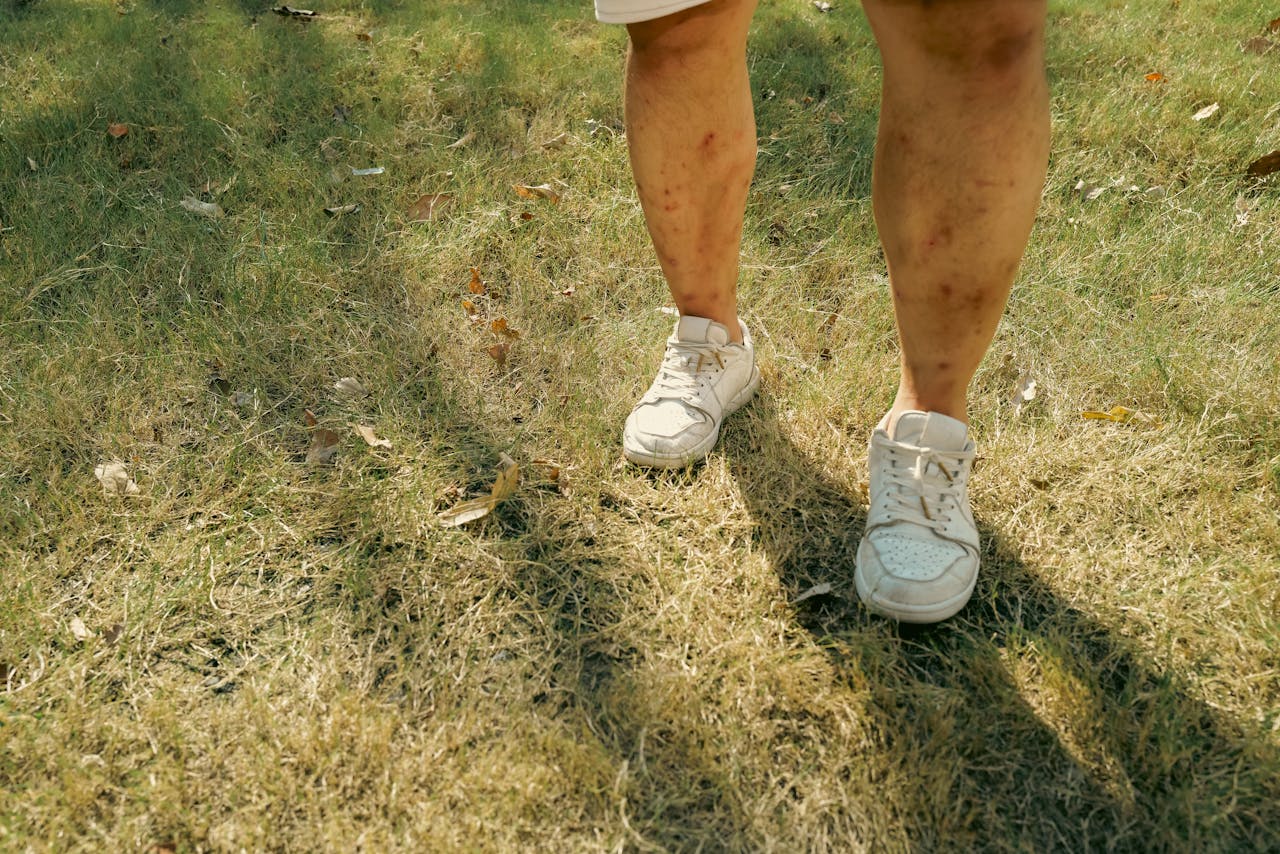 Foot Skin Treatment W Lancaster, SC